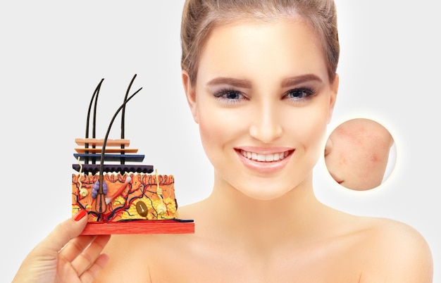 Post Acne Marks Treating Acne Scars Acne Scar Removal