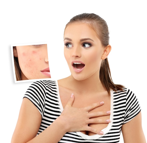 Post Acne Marks Treating Acne Scars Acne Scar Removal