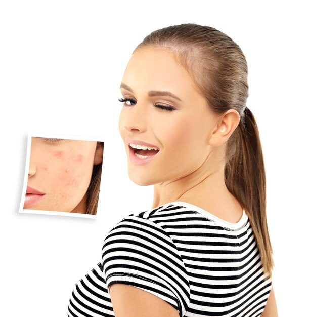 Post Acne Marks Treating Acne Scars Acne Scar Removal