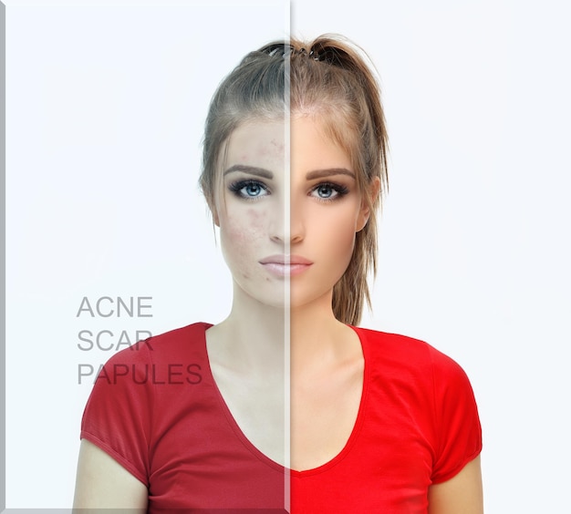 Post Acne Marks Treating Acne Scars Acne Scar Removal