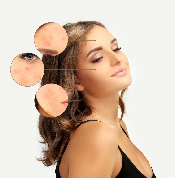 Photo post acne marks treating acne scars acne scar removal