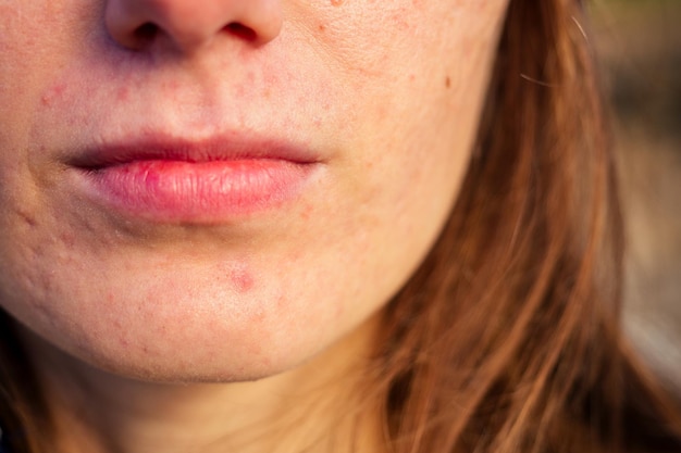 Post-acne, cicatrici e brufoli rossi purulenti sul viso di una giovane donna. concetto di problemi della pelle.