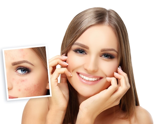 PostAcne Marks Treating Acne ScarsAcne Scar Removal