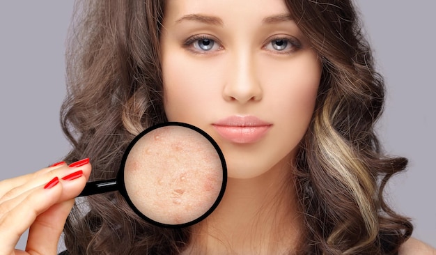 PostAcne Marks Treating Acne ScarsAcne Scar Removalx9