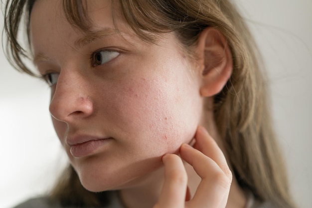 Probleem huid gezicht Een tienermeisje met een onrustig gezicht Problematische tiener huid Zorg voor een probleem huid Acne remedie Acne