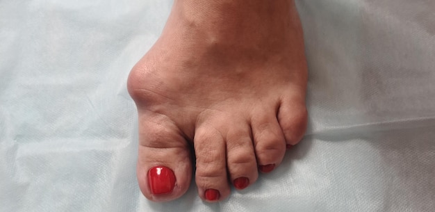 Problem foot with bunion and hallux valgus