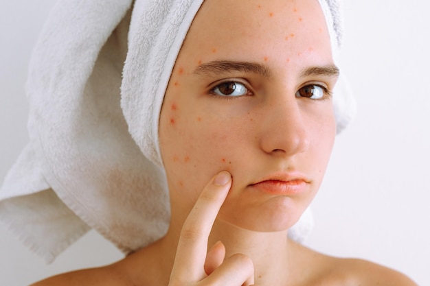 Pelle problematica adolescenziale, procedura cosmetica per la pulizia della pelle del viso, rimozione delle macchie nere