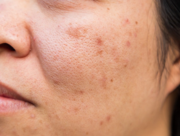 Foto i problemi della pelle del viso sono l'acne e le imperfezioni.