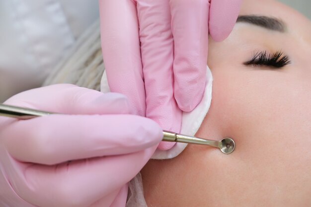 Procedure for cleaning the skin of the face with a steel appliance with a spoon uno from blackheads and acne.