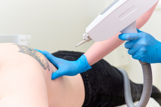 Procedure removal tattoo in laser cosmetology clinic.