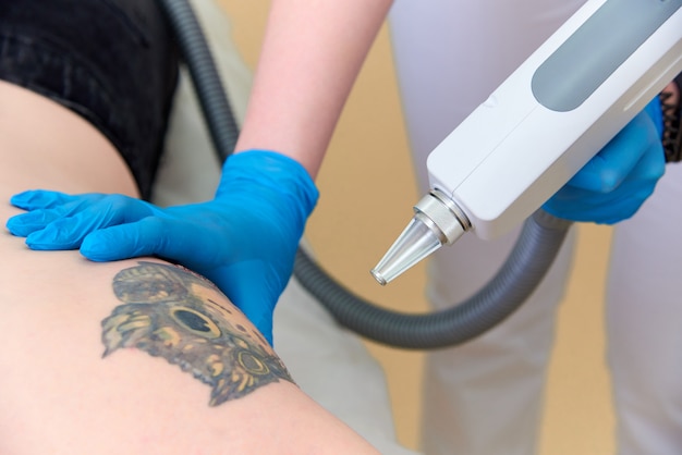 Procedure removal tattoo in laser cosmetology clinic.