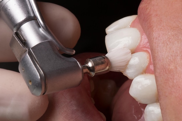 process of using stomatological brush as a stage of professional dental cleaning procedure in clinic close up