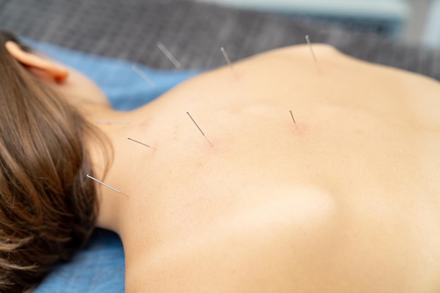 Professional spa needle therapy Needles back procedure
