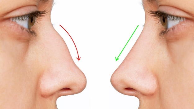 Profiel van het gezicht van de vrouw met neus voor en na neuscorrectie op witte achtergrond. Plastische chirurgie