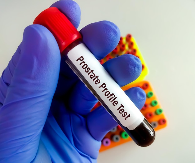 prostate profile test for the diagnosis of prostate gland functions