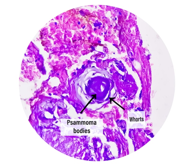 Photo psammoma bodies. spinal tumor biopsy. psammomatous meningioma