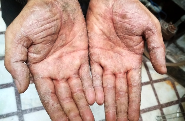 Malattia della psoriasi sulla mano dell'uomo. pelle dura e screpolata all'interno della mano maschile. pelle screpolata e squamosa sul palmo della mano. problemi dermatologici della psoriasi.