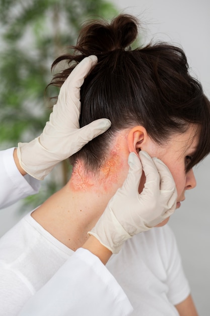 Photo psoriasis eczema on neck of patient