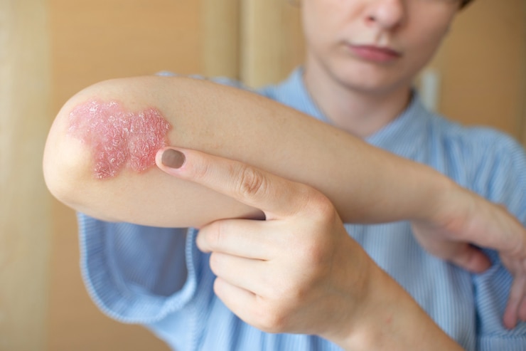 Фотография псориаз женщины на локтях, сидящей на полу спальни concept dermatology