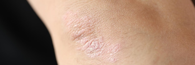 Psoriatic plaques on elbow of patient with skin disease closeup diagnosis and treatment of