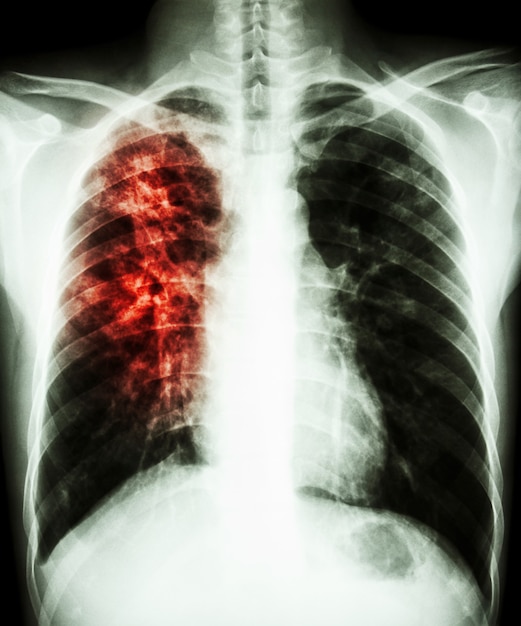 Pulmonary tuberculosis. Film chest x-ray show infiltration at right lung.