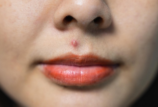 Photo purulent inflamed acne skin on the face of an asian woman