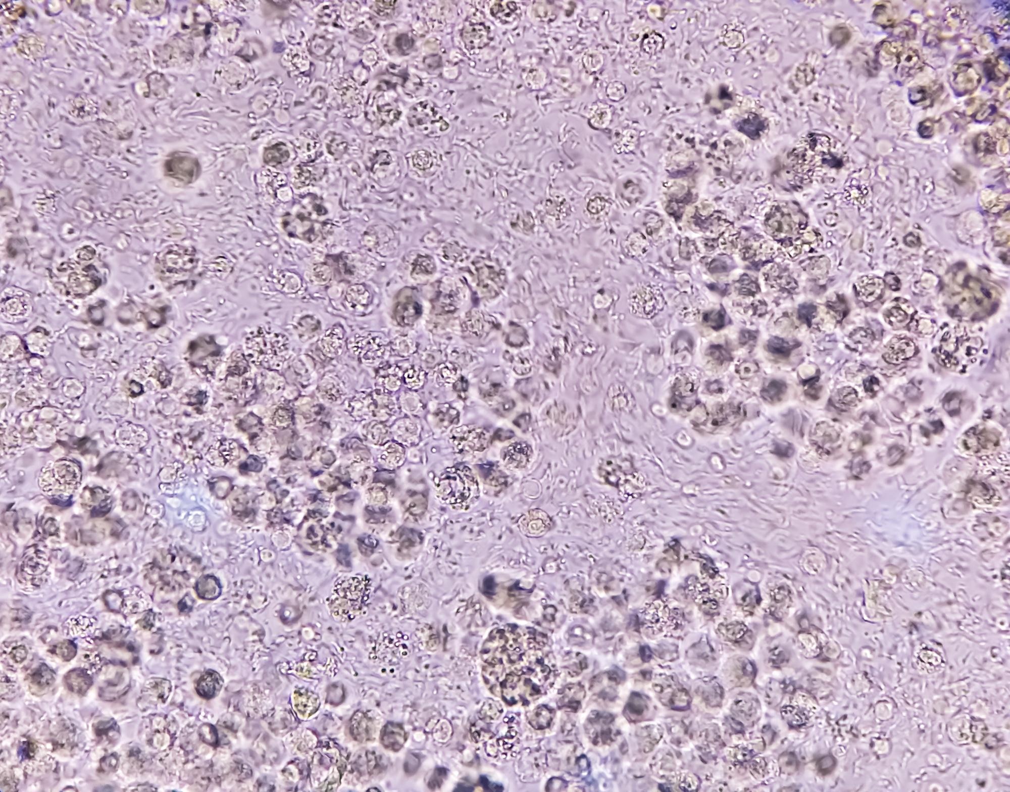 Rbc In Urine rbc-in-urine