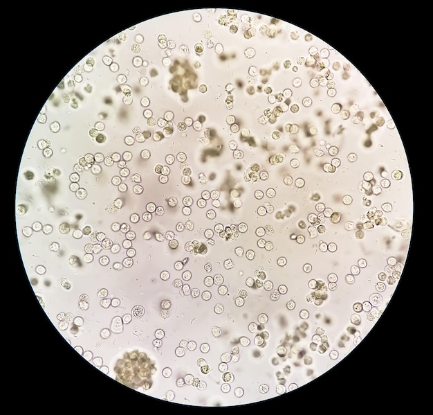 Pyurie of leukocyturie, het kan een teken zijn van een bacteriële urineweginfectie.