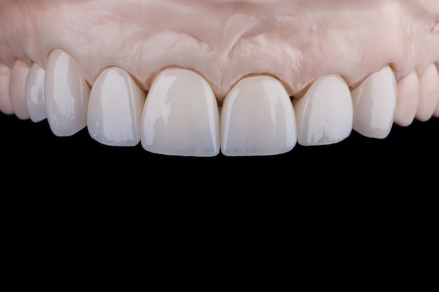 Quality dental prosthesis made of titanium beam and ceramics for fixation to the upper jaw teeth