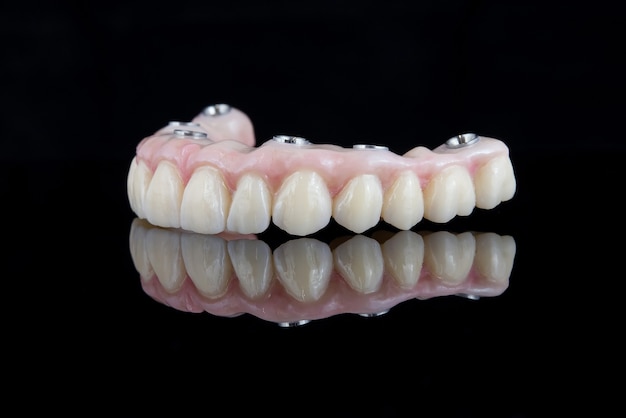 Quality dental prosthesis made of titanium beam and ceramics for fixation to the upper jaw