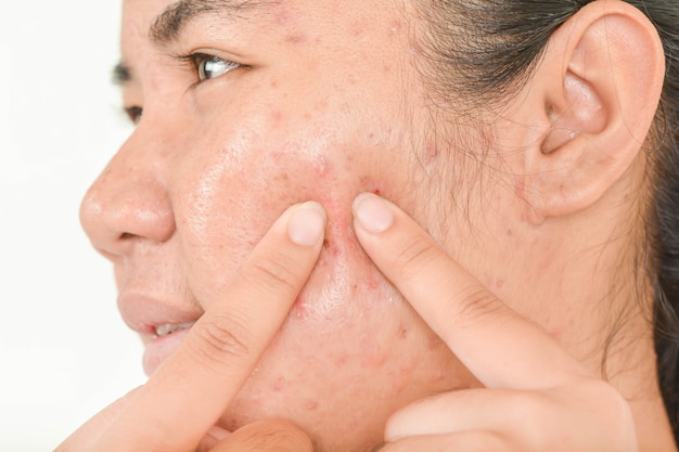 queezing acne and pressing acne.