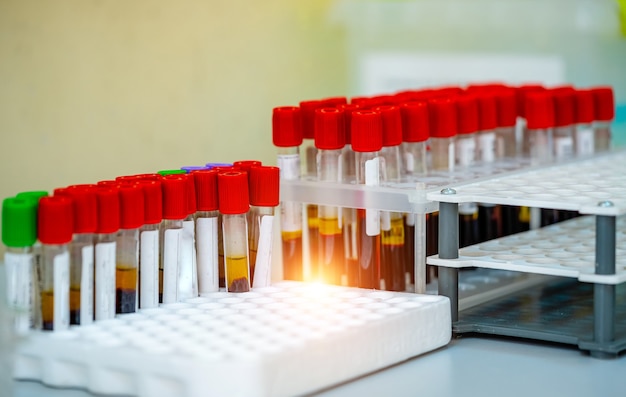 Rack of blood tubes test for analysis in the laboratory of hematology. Blood laboratory. Illness testing. Emergency testing. Virus infection.