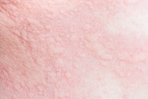 Rash on the body from allergies