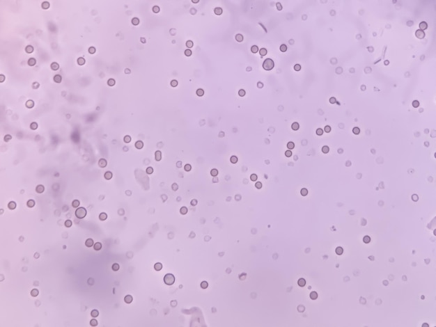 RBC WBC и бактерии в образце мочи анализируются под микроскопом