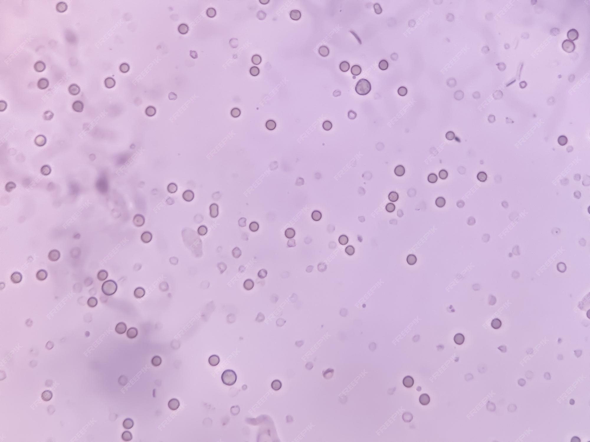 Premium Photo Rbc wbc and bacteria in urine specimen analysed by