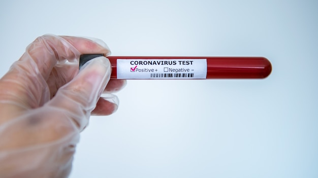 Reageerbuisje met geïnfecteerd bloedmonster voor COVID-19