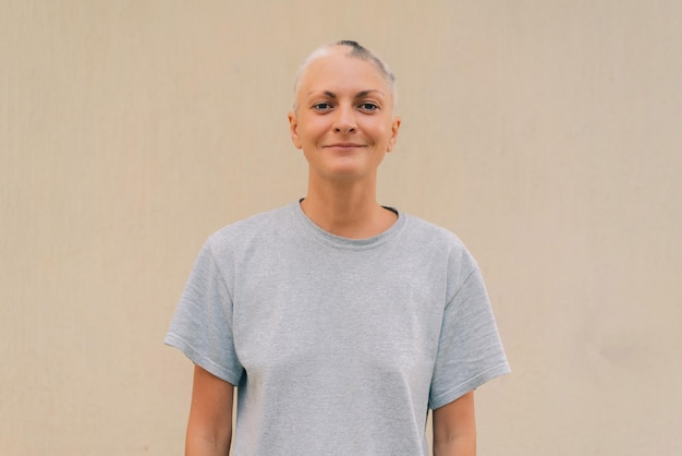 real alopecia areata in a young girl a bald head in a person diffuse alopecia