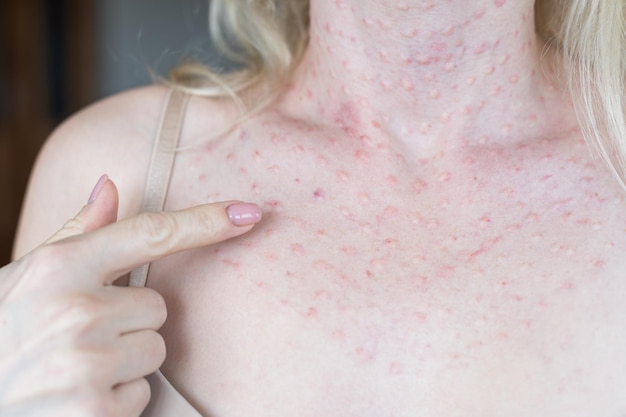 Real biorevitalization of the skin on a white background. Traces of injections of biorevitalization on the face of a woman. Traces of biorevitalization needles.