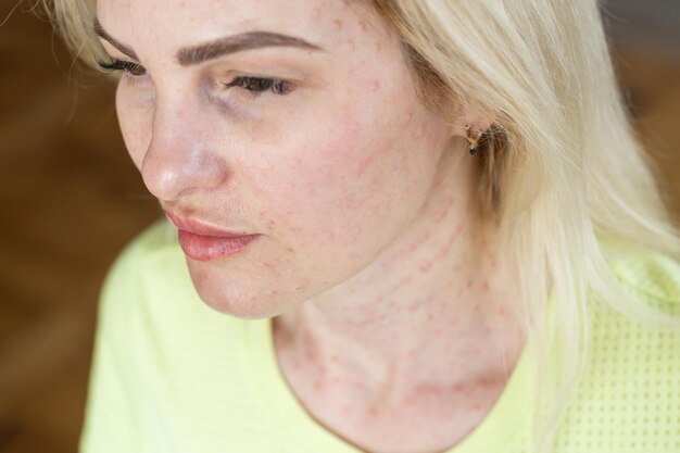 Real skin Biorevitalization on white background. Traces of biorevitalization injections on woman face. Biorevitalization needle marks Beauty treatment real papules after hyaluronic injection Close up.