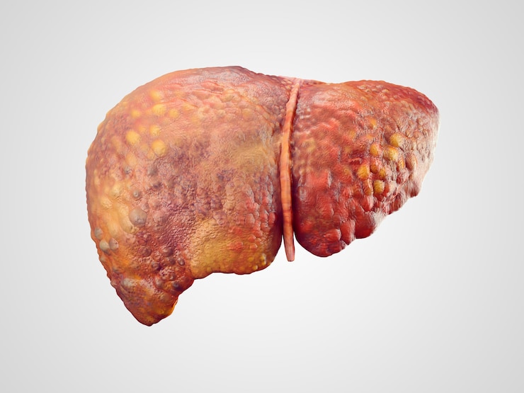 Photo realistic illustration of cirrhosis of human liver
