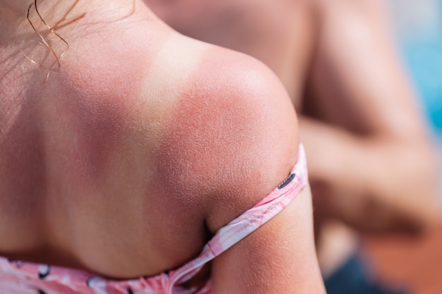 The red back of a girl with a sunburn and white lines from a swimsuit with a hotel pool on the backg...