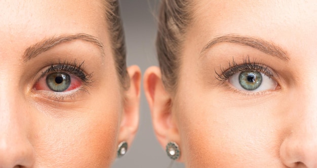 Red eye before and after the use of eye drop