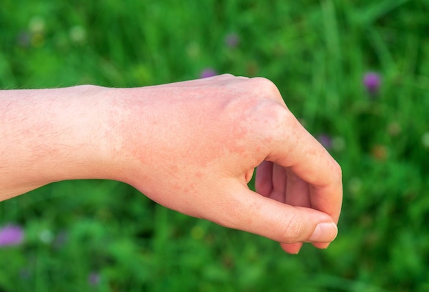 腕の真っ赤な太陽アレルギースポットは通常、痛みやかゆみを伴います。アレルギー性皮膚病。