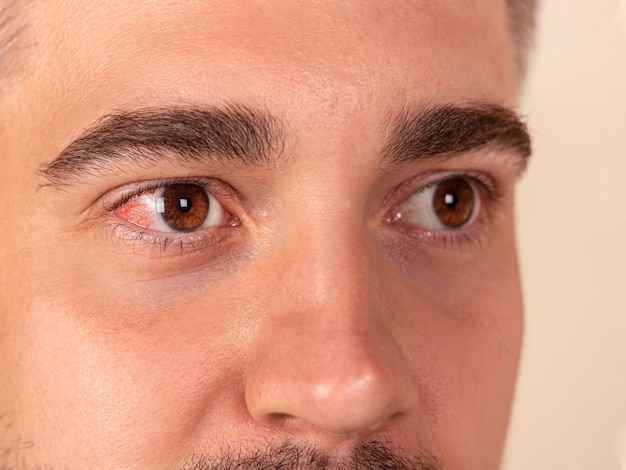 赤くて炎症を起こした目のクローズアップ 患者の目の充血 アレルギー反応