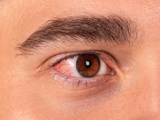 Красный и воспаленный глаз крупным планом Красный глаз пациента Аллергическая реакция
