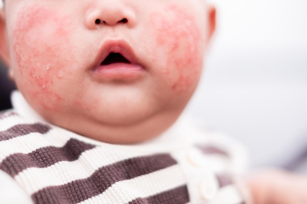 写真 赤い皮膚の発疹 赤ちゃんの顔に塵やアレルギーがあること 菌類 アレルギー 皮膚病 皮膚の乾燥 医療と医学の概念