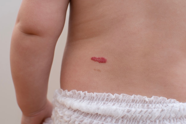 Red strawberry birthmark on the baby back, close up 