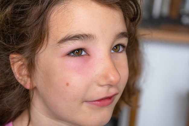 A red swollen eyelid on a child face in closeup is an allergy to an insect bite Allergic reaction to bloodsucking insects