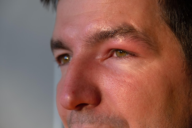 Красное опухшее веко на лице мужчины крупным планом - это аллергия на укус насекомого Аллергическая реакция на кровососущих насекомых
