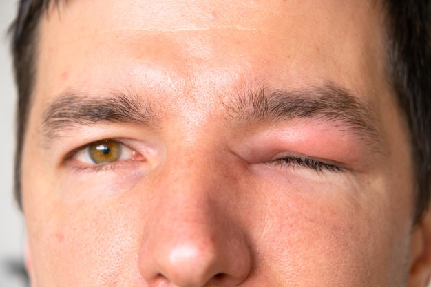 Красный опухший веко на лице человека в крупном плане - это аллергия на укус насекомого Аллергическая реакция на кровососущих насекомых